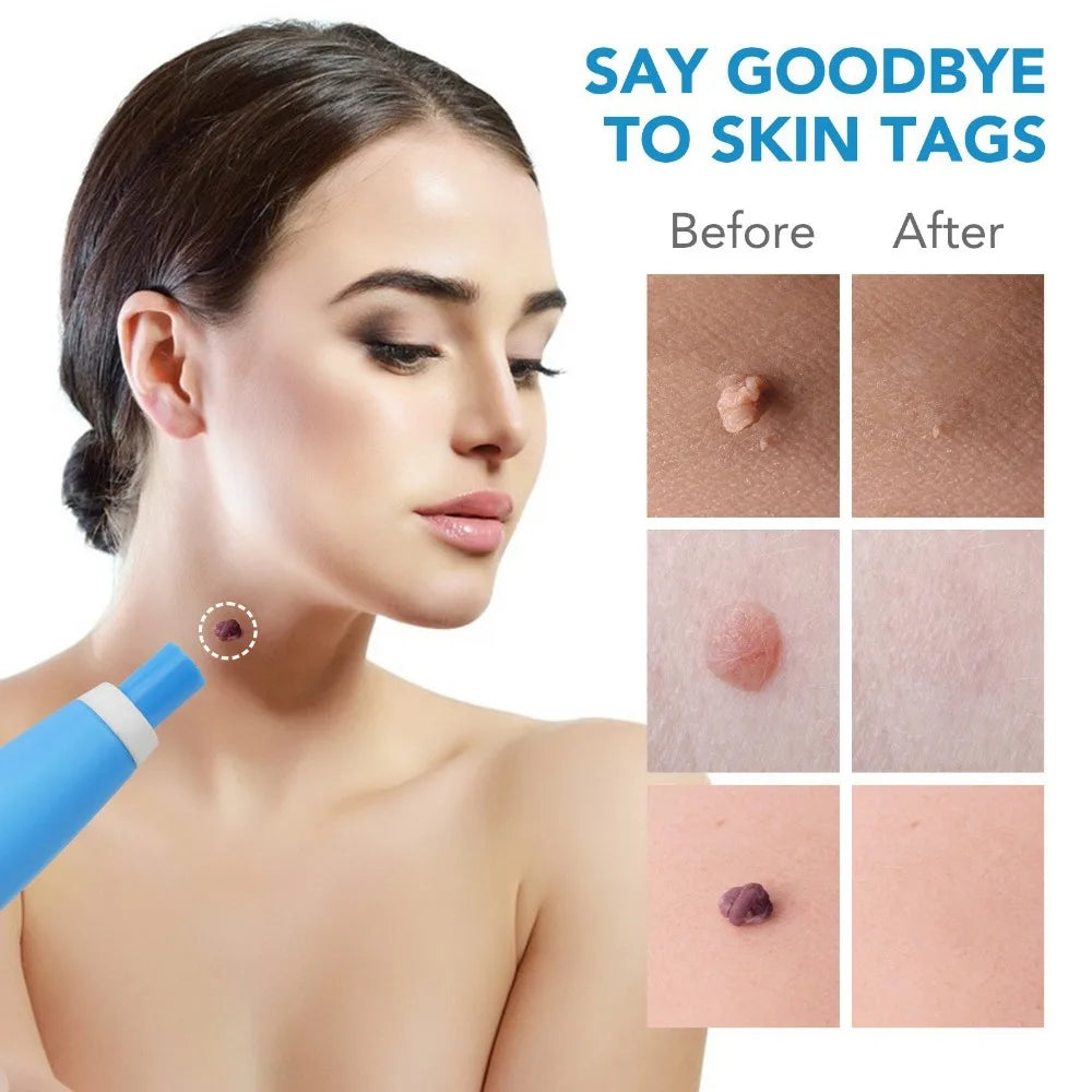 PAINLESS AUTO SKIN TAG  REMOVER KIT